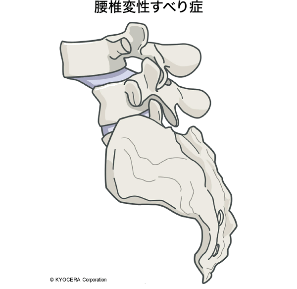 腰椎変性すべり症