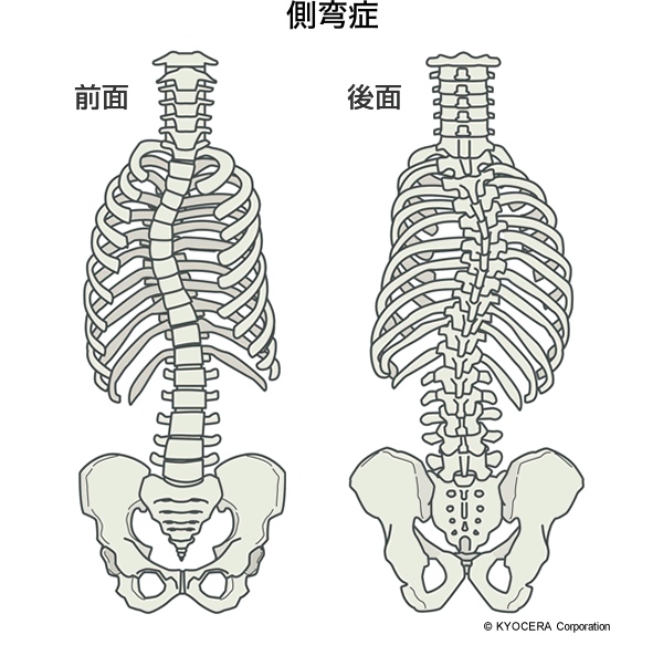 側弯症