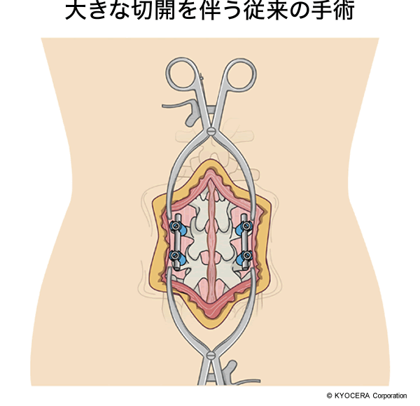 大きな切開を伴う従来の手術