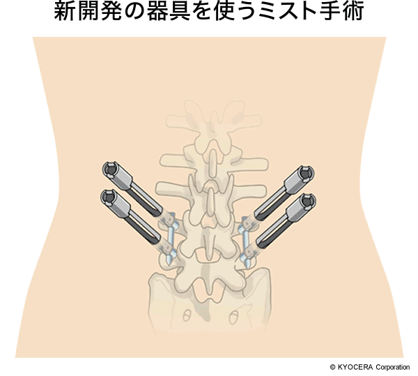 新開発の器具を使うミスト手術