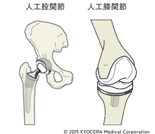 人工股関節 人工膝関節 イメージ