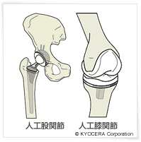 人工股関節 人工膝関節 イメージ