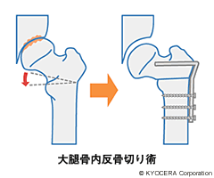 大腿骨内反骨切り術・外反骨切り術 イラスト