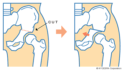 キアリ骨盤骨切り術 イラスト