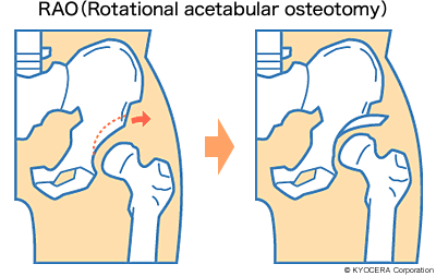 RAO（Rotational acetabular osteotomy） イラスト