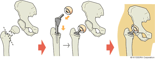 人工骨頭置換術 Bipolar Hip Arthroplasty Bha 関節とは 人工関節と関節痛の情報サイト 関節が痛い Com