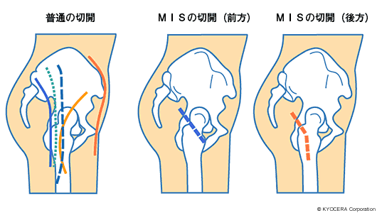 MIS（最小侵襲手術） イラスト