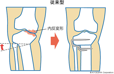 高位脛骨骨切り術 従来型 イラスト