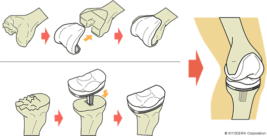 全人工膝（ひざ）関節置換術（Total Knee Arthroplasty:TKA)｜関節とは 