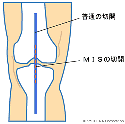 MIS（最小侵襲手術） イラスト