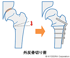 大腿骨内反骨切り術・外反骨切り術 イラスト