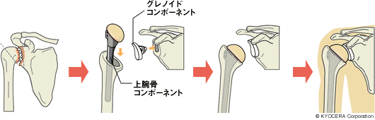 全人工肩関節置換術 イラスト