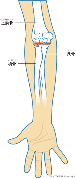 変形性肘関節症 イラスト