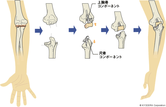 人工ひじ関節置換術 イラスト