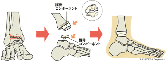 人工足関節置換術 イラスト