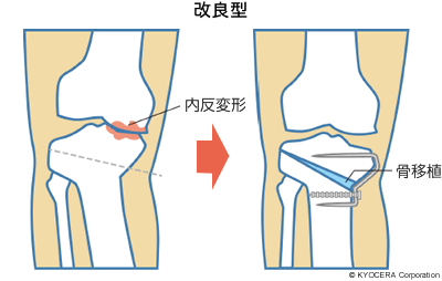 高位脛骨骨切り術 改良型 イラスト