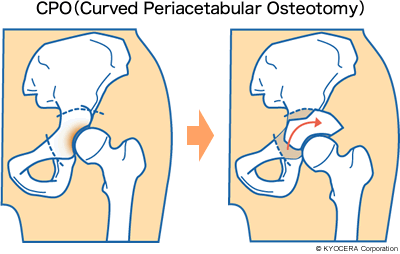 CPO（Curved Periacetabular Osteotomy） イラスト