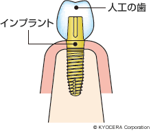 インプラント埋入イメージ